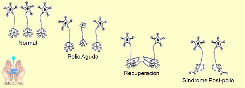 omcetpac